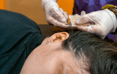  terapeuta de auriculoterapia poniendo agujas , semillas y chinchetas en la oreja de una paciente durante  una sesión de auriculoterapia . - obrazy, fototapety, plakaty