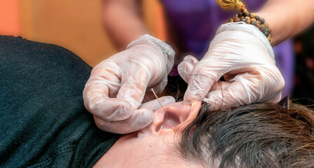  terapeuta de auriculoterapia poniendo agujas , semillas y chinchetas en la oreja de una paciente durante  una sesión de auriculoterapia . - obrazy, fototapety, plakaty