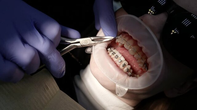 Close-up of a doctor and a patient with a mouth dilator in the dental office, braces on the teeth, various procedures are performed with the help of dental instruments.