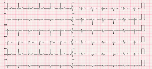 ECG example of a normal 12-lead sinus rhythm 