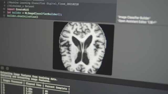 2.37 Real Neural Network Machine Learning Analyzes Alzheimer Disease on Brain Computer X-Ray CT Scan Image