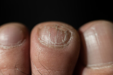 Close-up of male toes with a cracked nail