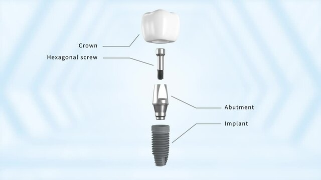Titanium alloy implant structure description
