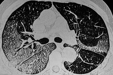 Ground Glass, opacities, crazy-paving, adenovirus pneumonia shows bilateral multifocal GGO with patchy consolidations on CT image. 
