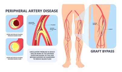 Graft artery PAD flow legs pain fatty treat hips Calf toes feet High heart ABI foot test Ankle clot injury arms stent veins Sores index attack venous ulcers blood limbs