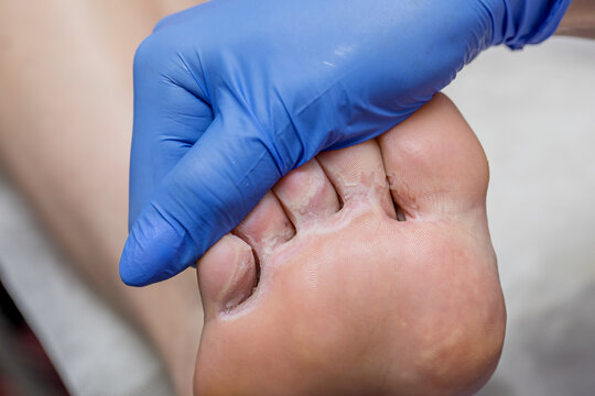 A podiatrist examines a sore foot with hyperhidrosis. Damaged skin with cracks. Medical pedicure in a beauty salon.