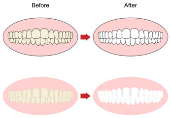 歯のホワイトニングビフォーアフターイメージを正面から見たセット