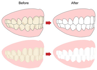 歯のホワイトニングビフォーアフターイメージを斜めから見たセット