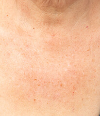 pigmentation on the skin in the neck and chest area as a background