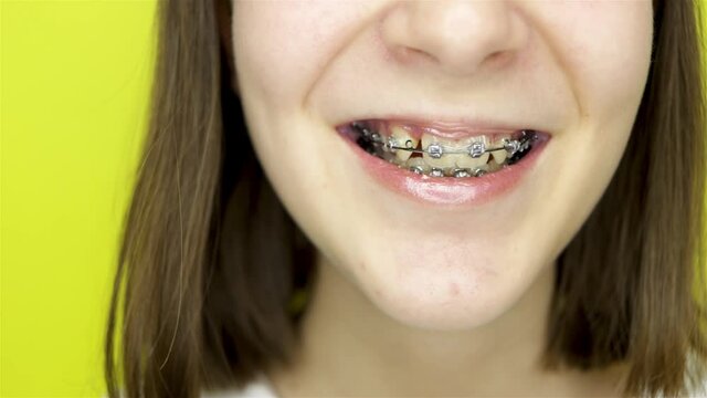 A smiling teenage girl with orthodontic braces or brackets