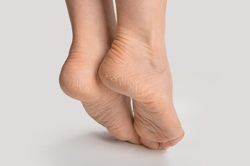 foot with dry skin on heel and sole. women female feet with rough cracked skin isolated on gray background, close up, copyspace