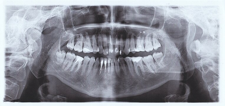 Panoramic tooth shot. dental X-Ray image of teeth