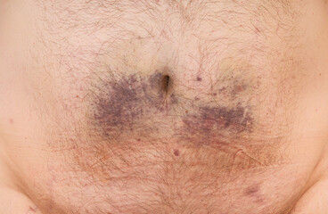 bruises on the abdomen from injections after treatment with COVID-19