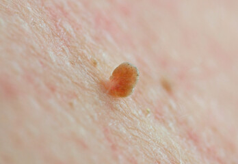 Close up knot skin tag on human skin Caucasian man middle age. Imperfect skin concept