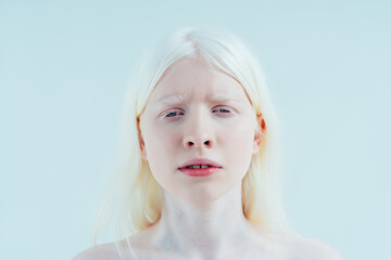 Beauty image of an albino girl posing in studio wearing lingerie. Concept about body positivity, diversity, and fashion - obrazy, fototapety, plakaty