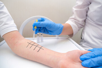 Immunologist Doing Skin Prick Allergy Test.