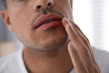 Man with herpes touching lips against blurred background, closeup