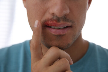 Fototapeta premium Man with herpes touching lips against light background, closeup