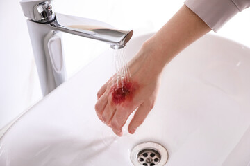 Woman putting burned hand under running cold water indoors, closeup
