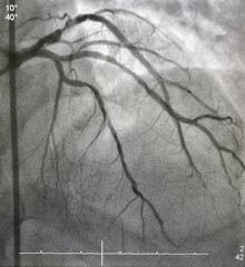 Coronary angiogram shown dual left anterior descending artery (LAD) with left circumflex artery...