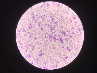 Immature and mature white blood cells.Segmented neutrophil,blast cells myelocyte,metamyelocyte,Band form in blood smear,