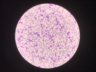 Immature and mature white blood cells.Segmented neutrophil,blast cells myelocyte,metamyelocyte,Band form in blood smear,