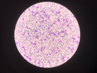 Immature and mature white blood cells.Segmented neutrophil,blast cells myelocyte,metamyelocyte,Band form in blood smear,