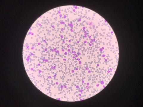 Immature and mature white blood cells.Segmented neutrophil,blast cells myelocyte,metamyelocyte,Band form in blood smear,