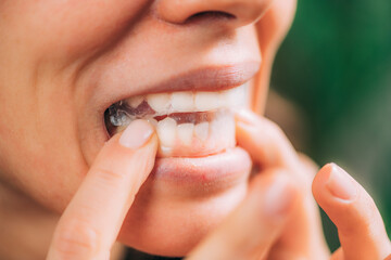 Whitestrips or Teeth Whitening Strips.