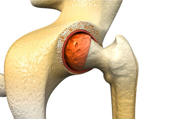 Human hip joint. arthritis of the hip joint. 3d illustration - obrazy, fototapety, plakaty