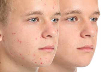 Teenage boy before and after acne treatment on white background