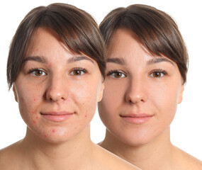 Young woman before and after acne treatment on white background