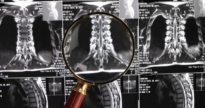 MRI lumbar spine background, magnetic resonance tomography. Doctor examines MRI of lumbar spine with pinched discs of spine and nerves.