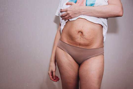 Woman with figure after pregnancy with stretch marks on her belly.