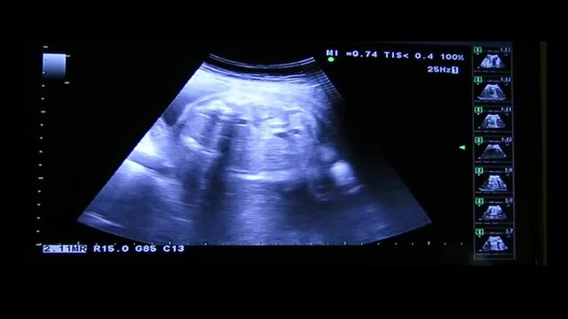 Kidney of human embryo on an ultrasound display