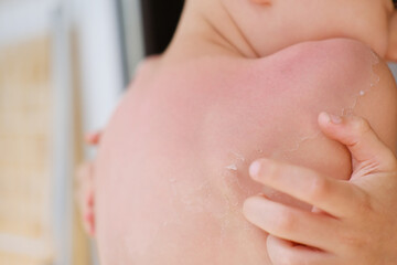 back of a child with sunburns and peeling dead skin of a 6-7 year old boy with sunscreen, body...