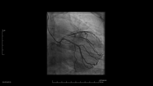 X-ray images of blood pumping through the veins during a cardiac catheterization of the right coronary.