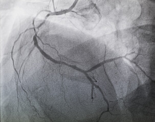 Coronary angiogram , medical x-ray for heart disease. Coronary artery disease.