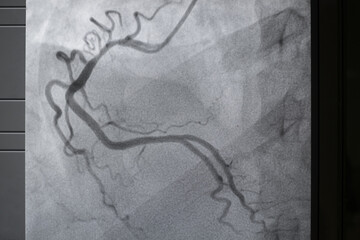 Coronary angiogram , medical x-ray for heart disease. Coronary artery disease.