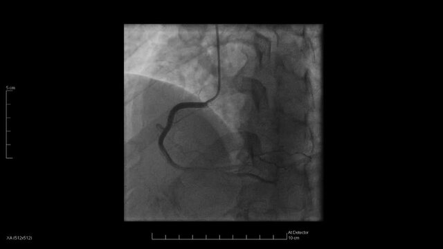 Medical imaging of a cardiac catheterization of the right coronary. View of the hospital computer screen as the technician takes photos during a medical test with the spine and ribs in view.