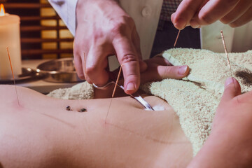 Acupuntura
