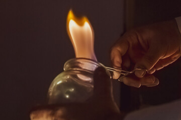 Medicina tradicional china ventosas