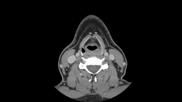 Axial CT Computed Tomography scan layers of head and chest, no text