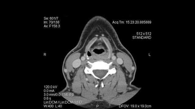 Axial Tomography: CT Scan layers from top of head to mid-thoracic