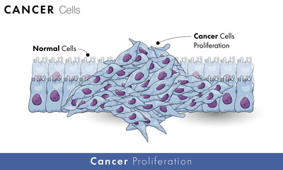 
Cancer cell proliferation in healthy tissue or healthy cells with labelling. Abnormal growth of normal cells in human body vector graphic illustration