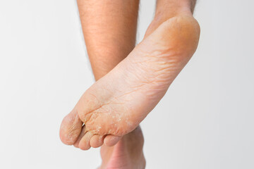 Close up of dry feet. Peeling and cracked foot. Fungal infection or athlete's foot, dry skin, dermatitis, eczema, psoriasis, sweaty feet or dehydration. Health care concept