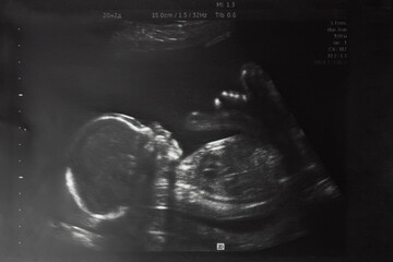 Image of baby in mother's womb during ultrasound examination at 20 weeks 2 days.