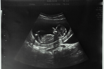 Image of mother's womb ultrasound during pregnancy. Ultrasound of a fetus at 12 weeks 6 days.