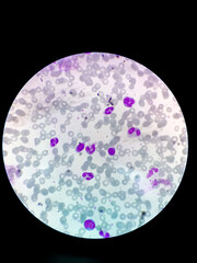 Microscopic view of hematology slide. RBC. WBC. closeup. Stained slide. Smear. Platelet, blood film
