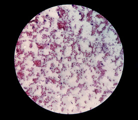 Microscopic view of hematology slide. RBC. WBC. closeup. Stained slide. Smear. Platelet, blood film